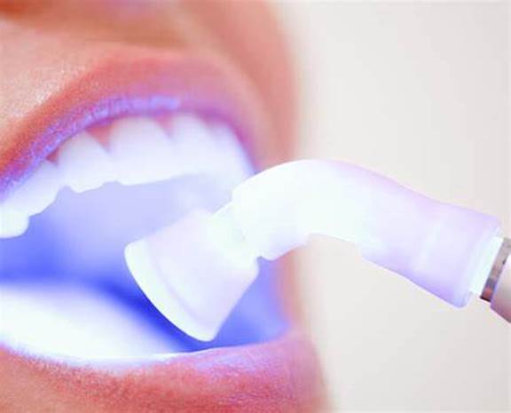 کامپوزیت دندان 
